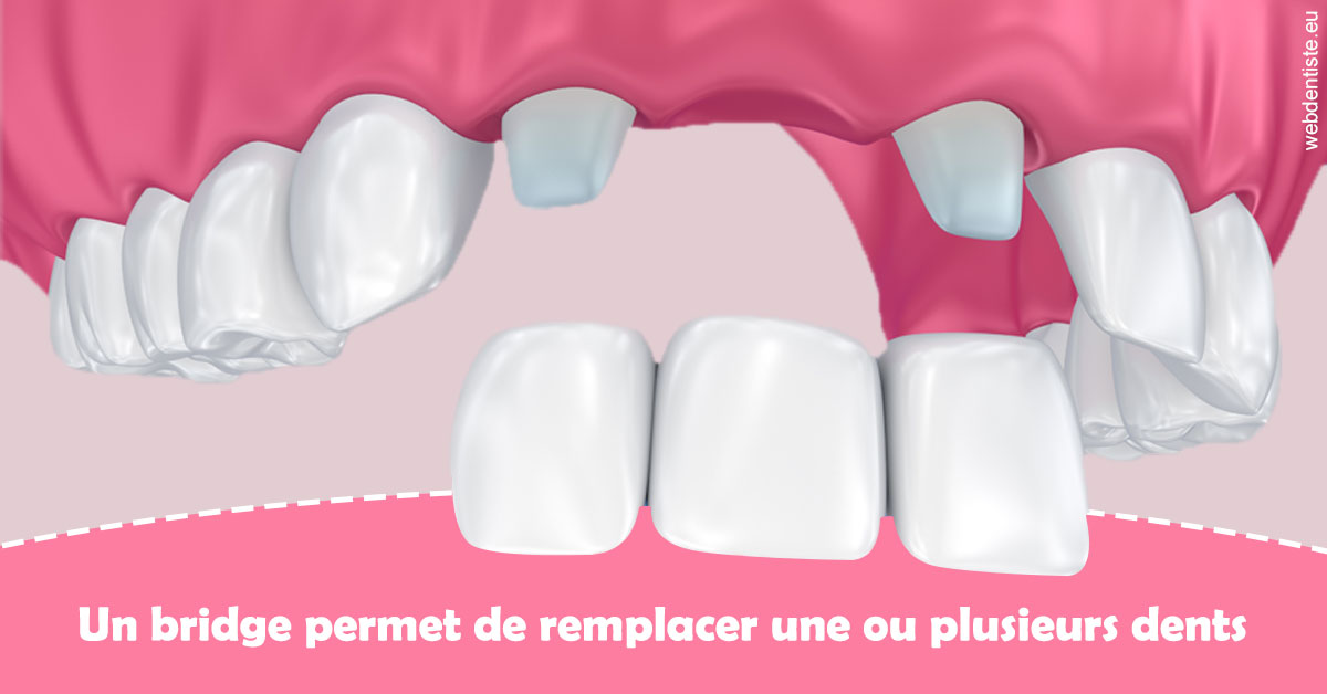 https://dr-gritli-soraya.chirurgiens-dentistes.fr/Bridge remplacer dents 2