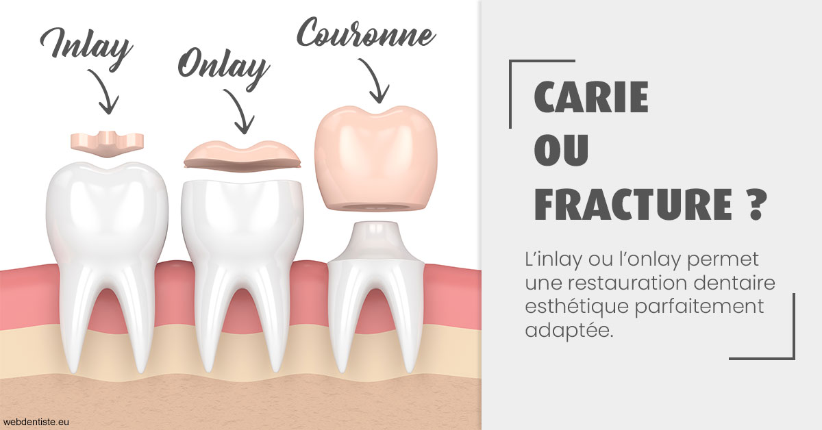 https://dr-gritli-soraya.chirurgiens-dentistes.fr/T2 2023 - Carie ou fracture 1